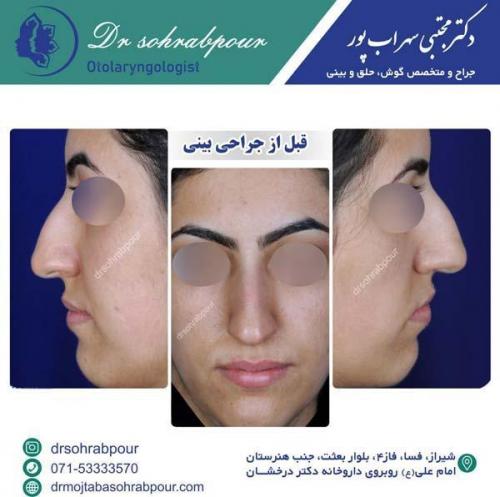 جراحی-بینی-168