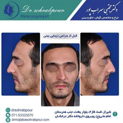 جراحی-بینی-169