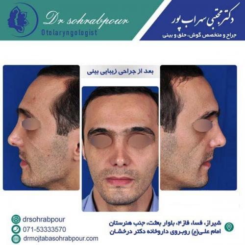 جراحی-بینی-170