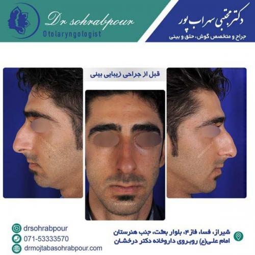 جراحی-بینی-171