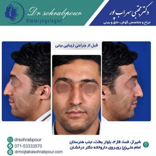 جراحی-بینی-175