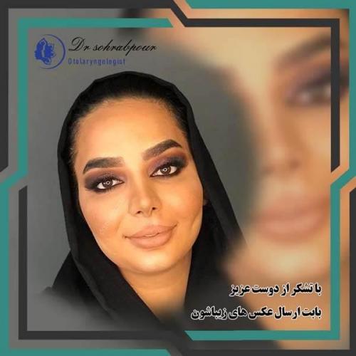 جراحی-بینی-178