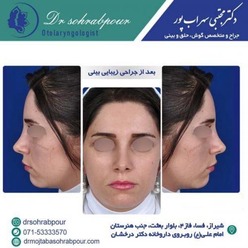 جراحی-بینی-180