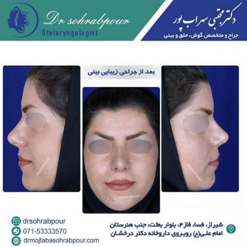 جراحی-بینی-182