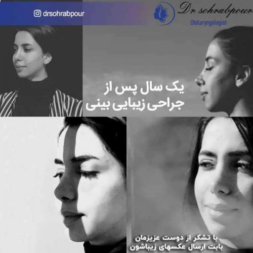جراحی-بینی-183
