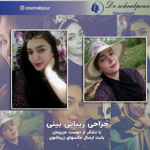 جراحی-بینی-184