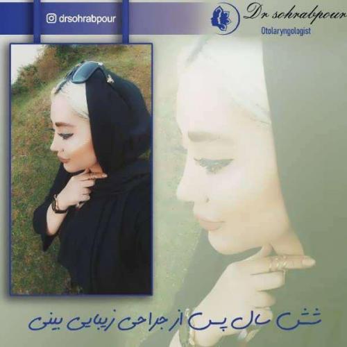 جراحی-بینی-186