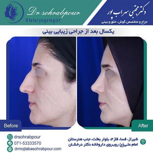 جراحی-بینی-200