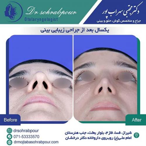 جراحی-بینی-202