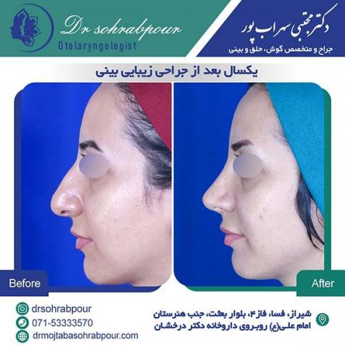 جراحی-بینی-206