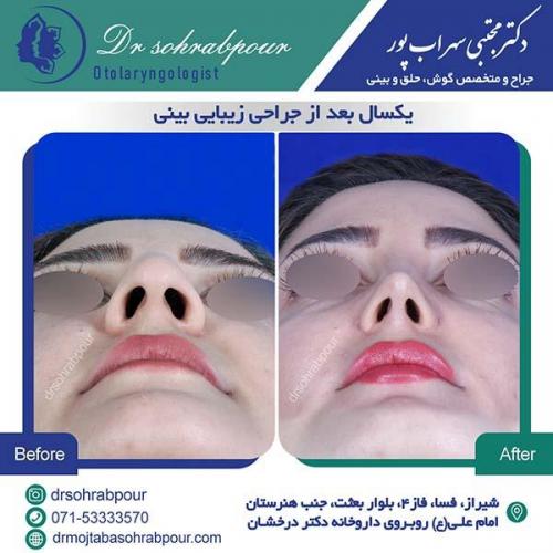 جراحی-بینی-217