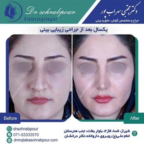 جراحی-بینی-220
