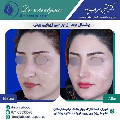 جراحی-بینی-221