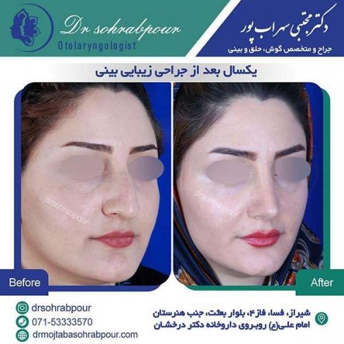 جراحی-بینی-222