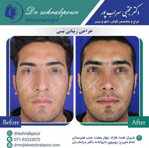 جراحی-بینی-3