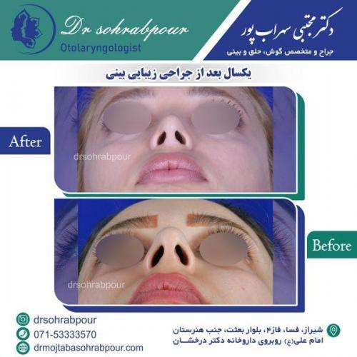 جراحی-بینی-31