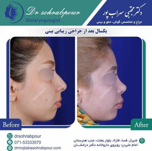 جراحی-بینی-32