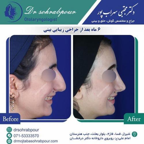 جراحی-بینی-33