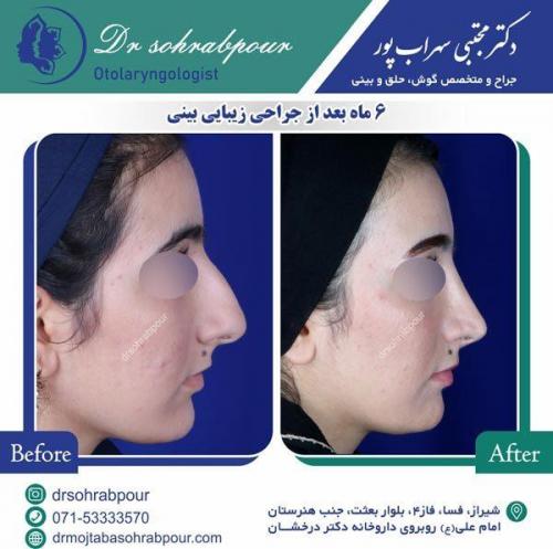 جراحی-بینی-34