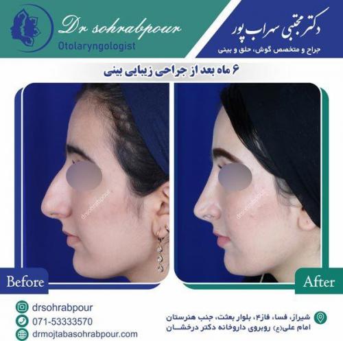 جراحی-بینی-35