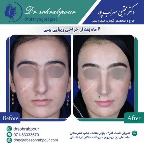 جراحی-بینی-36