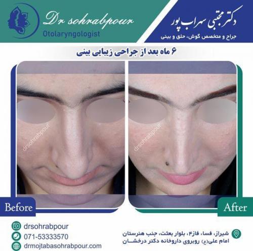 جراحی-بینی-37