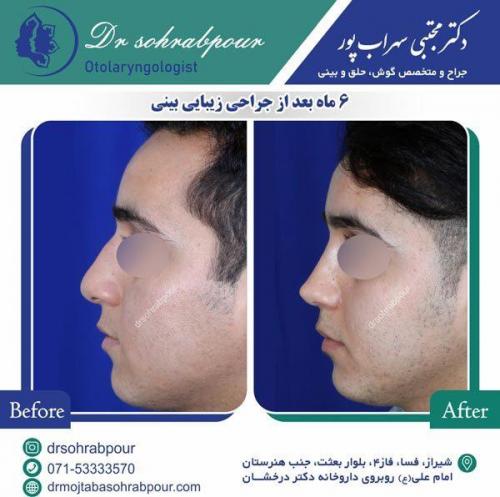 جراحی-بینی-44