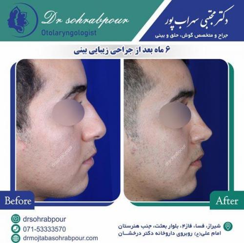 جراحی-بینی-45