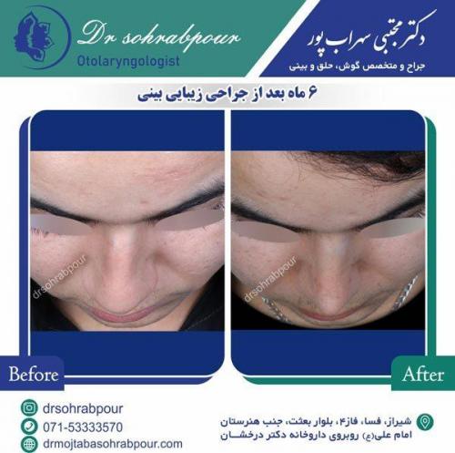جراحی-بینی-47
