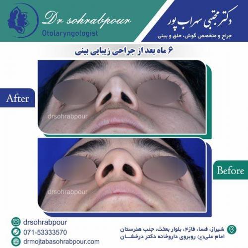 جراحی-بینی-48