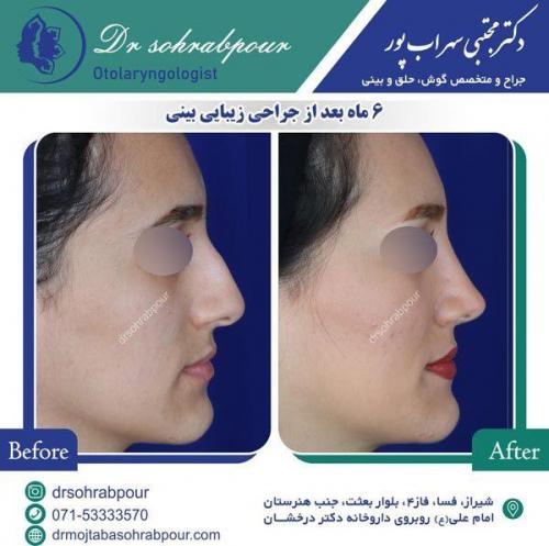 جراحی-بینی-54