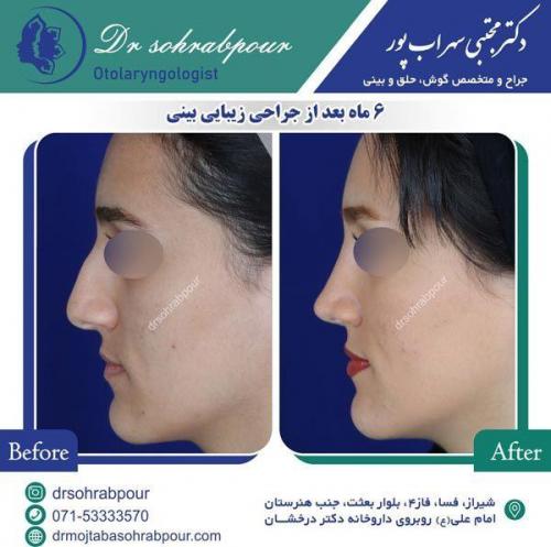 جراحی-بینی-55