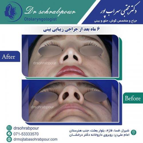 جراحی-بینی-57
