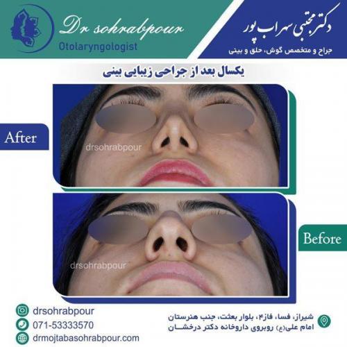 جراحی-بینی-58