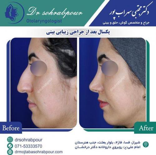 جراحی-بینی-59