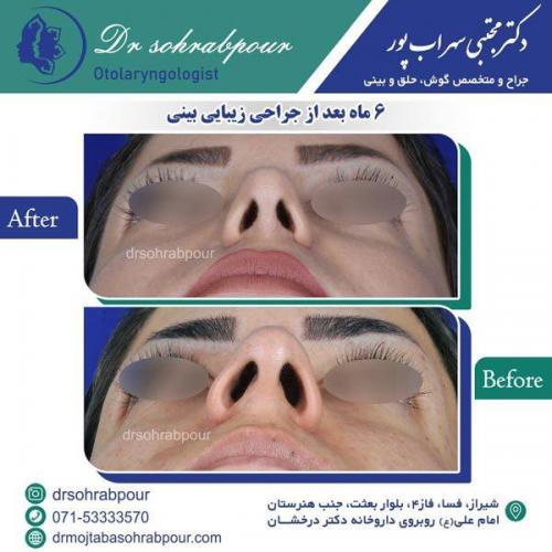 جراحی-بینی-82