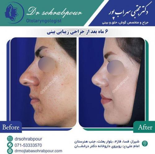 جراحی-بینی-83