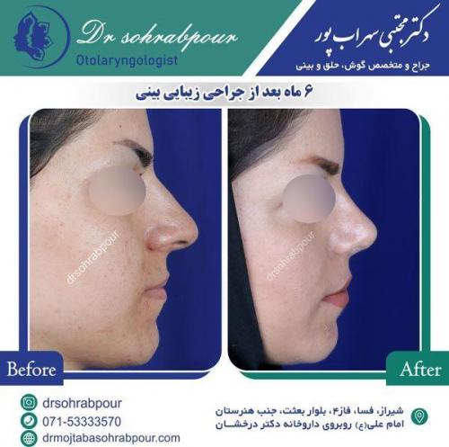 جراحی-بینی-84