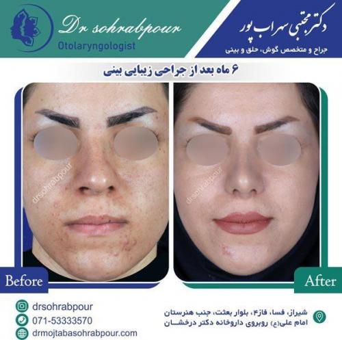 جراحی-بینی-85