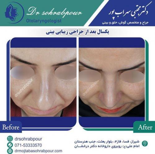 جراحی-بینی-86