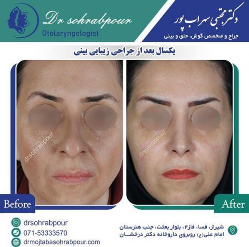 جراحی-بینی-87