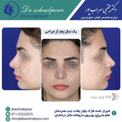 جراحی-بینی-در-شیراز-209 (1)