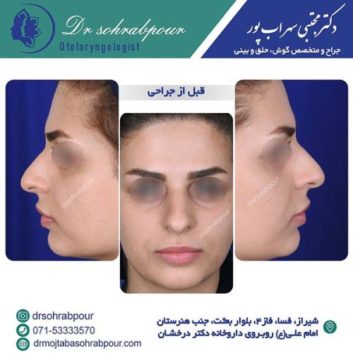 جراحی-بینی-در-شیراز-210