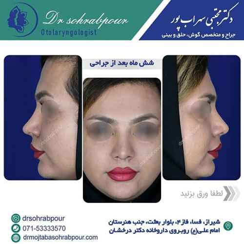 جراحی-بینی-در-شیراز-211