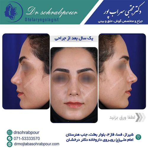 جراحی-بینی-در-شیراز-212