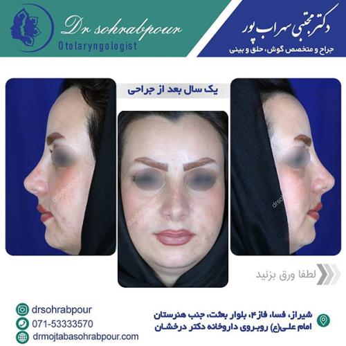 جراحی-بینی-در-شیراز-213