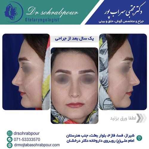 جراحی-بینی-در-شیراز-214