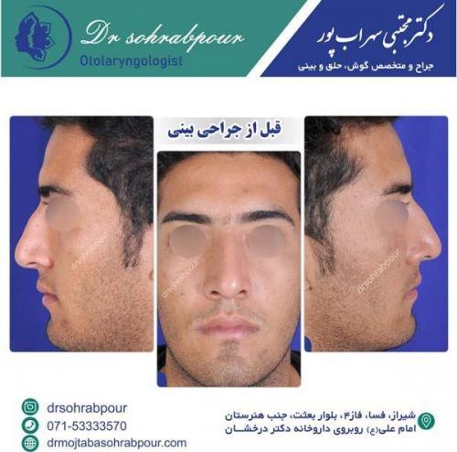 قبل-از-جراحی-بینی-1