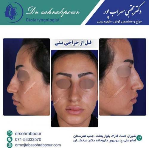 قبل-از-جراحی-بینی-2