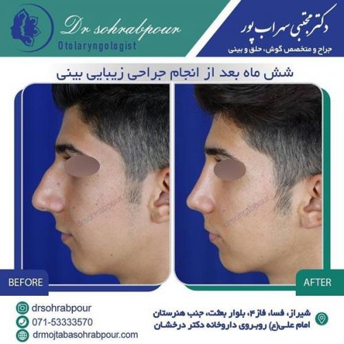 جراحی بینی در شیراز 1